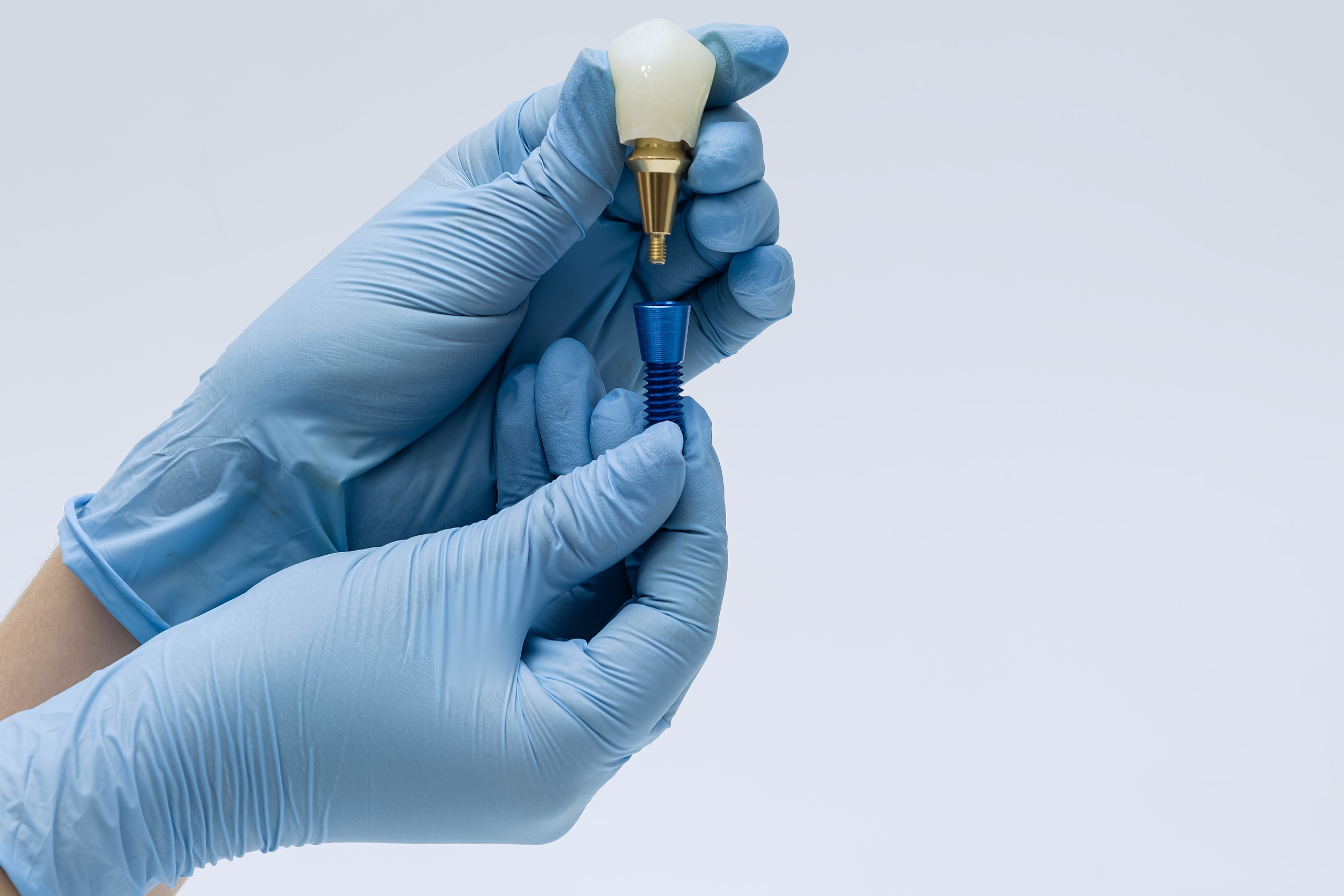 Which Often Country Abroad If You Choose To Have Dental Care Implants In 2023