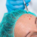 When Should You Start Receiving Anti Wrinkle Injections