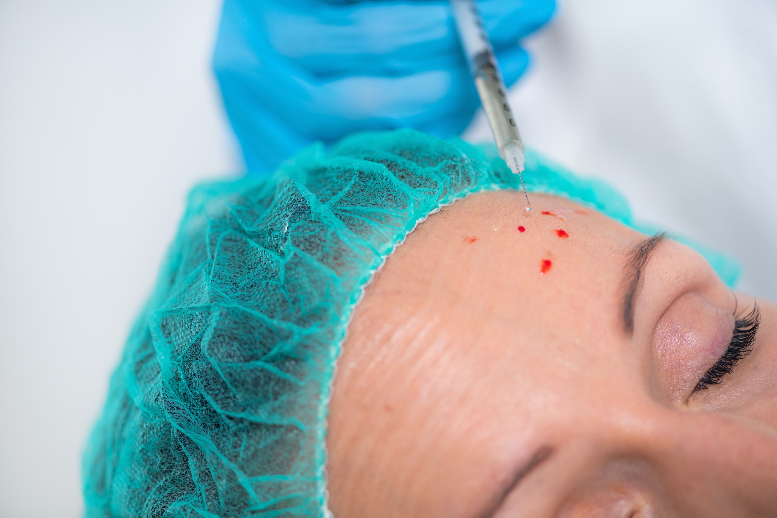 When Should You Start Receiving Anti Wrinkle Injections