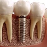 Dental Implants - Where You Can Get Dental Implants Abroad
