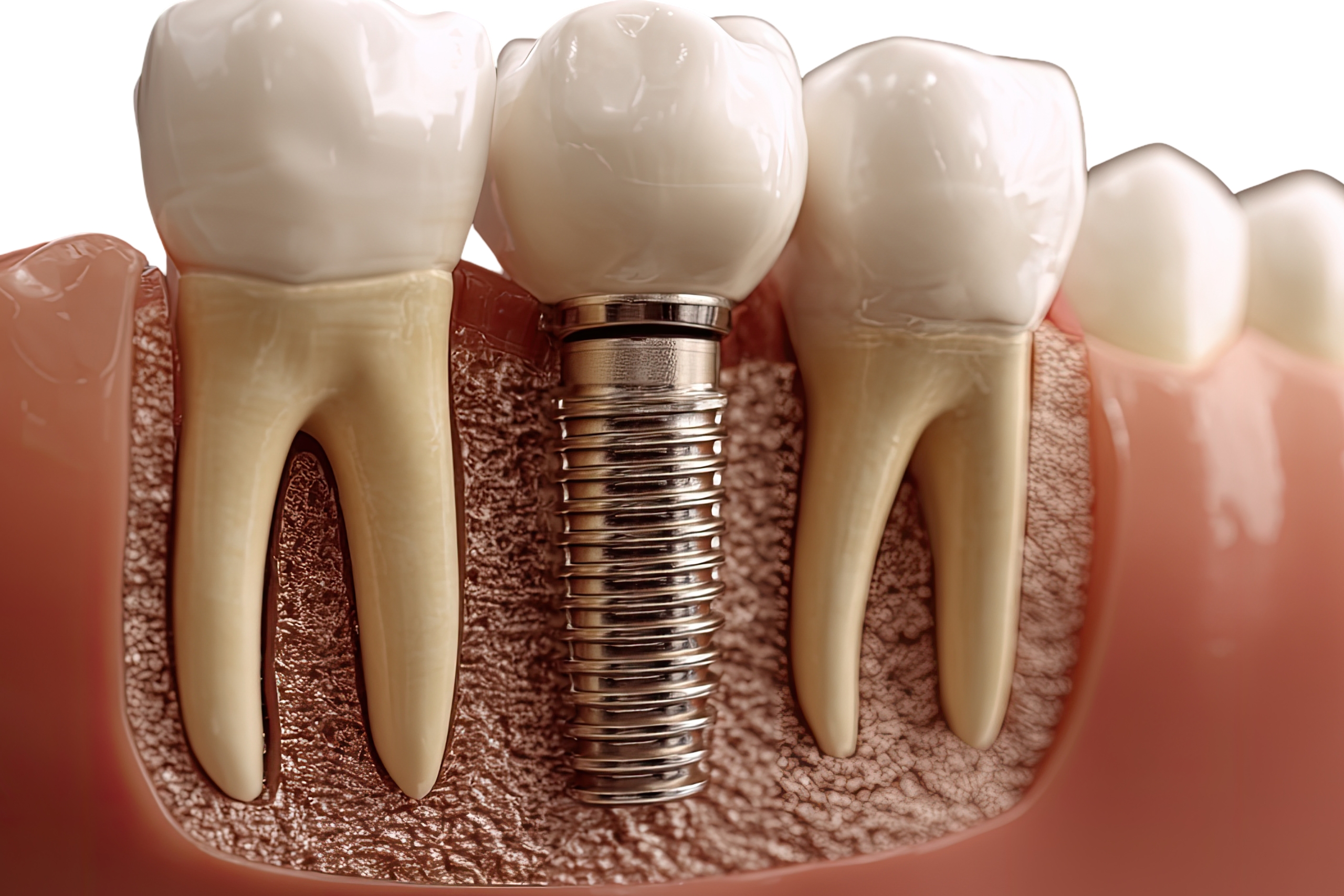 Dental Implants - Where You Can Get Dental Implants Abroad